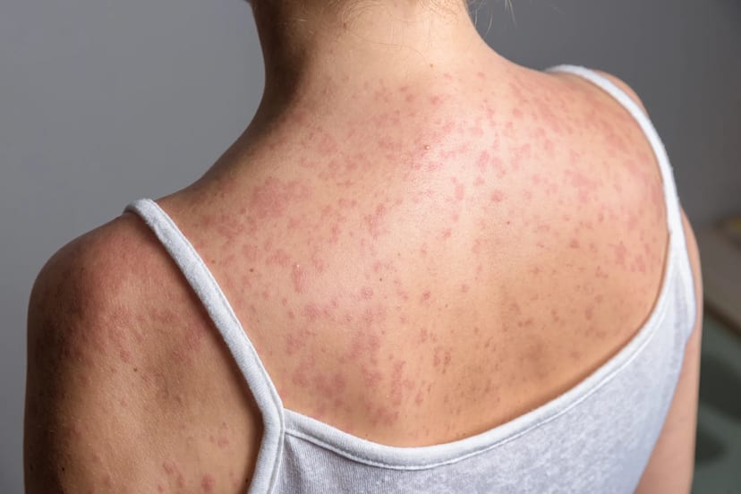 Wisconsin Measles Hits 171 Cases as Virus Reaches Chippewa County